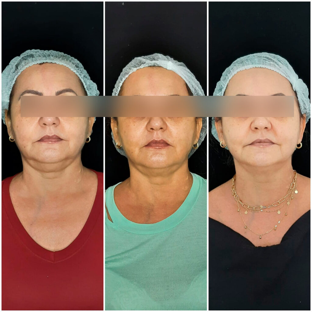 LIPOPAPADA COM ULTRASSOM