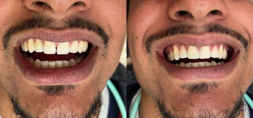 antes-e-depois-1